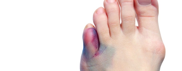 Photograph of A foot with a bruised and swollen toe and a bunion